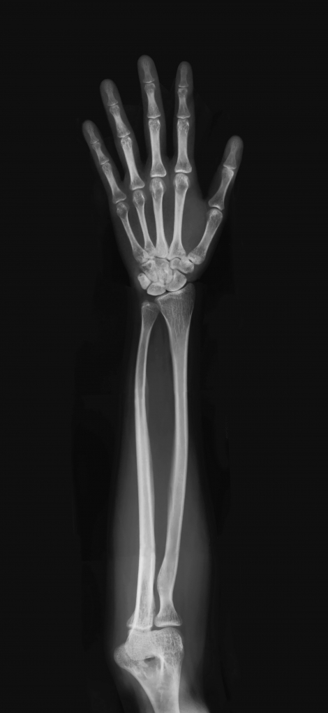 X-Ray